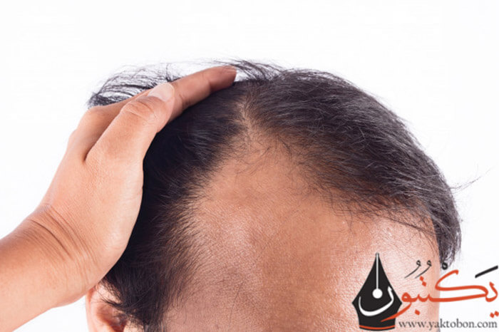 أسباب تساقط الشعر عند الرجال | أهم طرق العلاج الحديثة